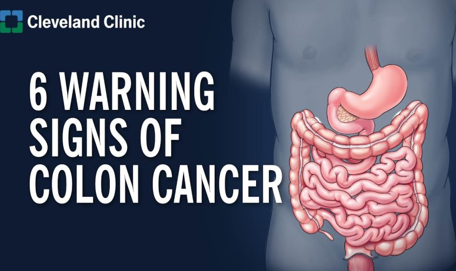 What are the Symptoms of Bowel Cancer? What Causes Bowel Cancer?
