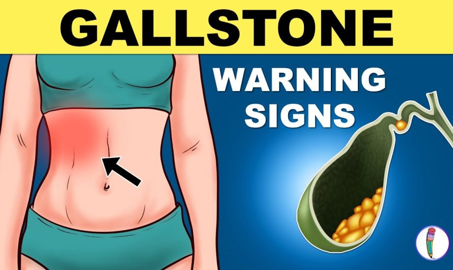 What are the Symptoms of Gallbladder Stones?