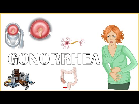 What are the Symptoms of Gonorrhea?