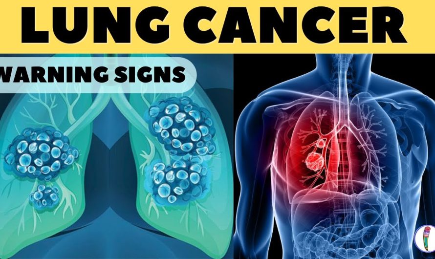 What are the Symptoms of Lung Cancer?