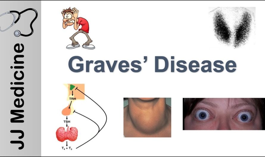 What are the Symptoms of Poisoning in Graves’ Disease?