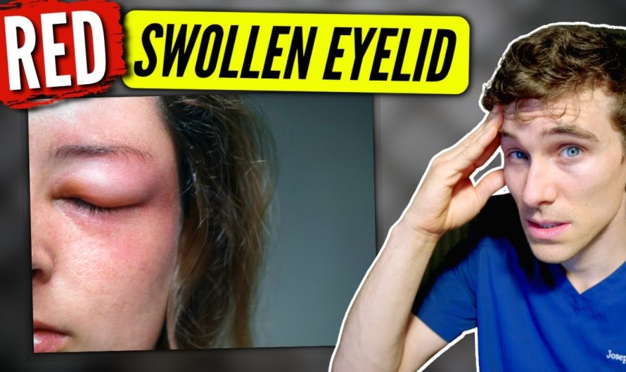 What causes eyelid swelling, what is good for eyelid swelling?