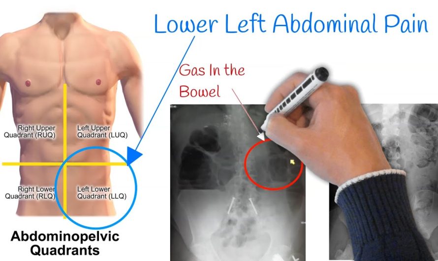 What Causes Lower Left Abdominal Pain?