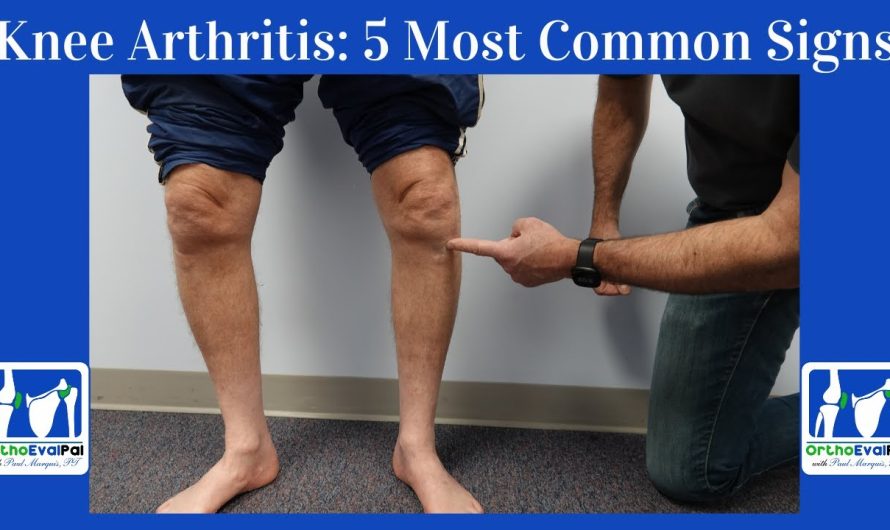 What is good for knee arthritis?