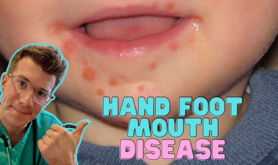 What is hand and foot disease in children, how is it treated?