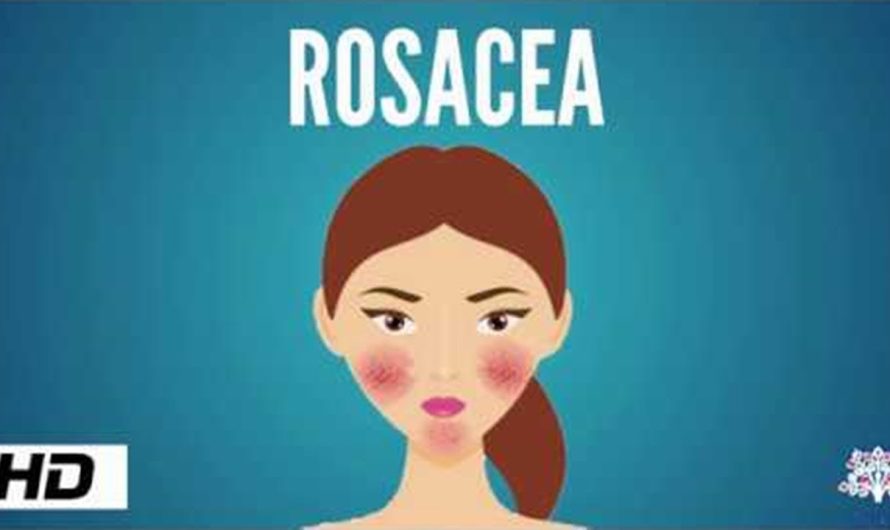 What is rosacea, what are the symptoms of rosacea, how is rosacea treated?