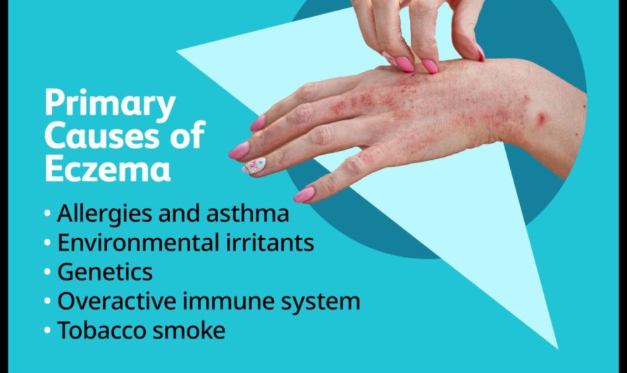 Eczema What Causes It and How to Manage It